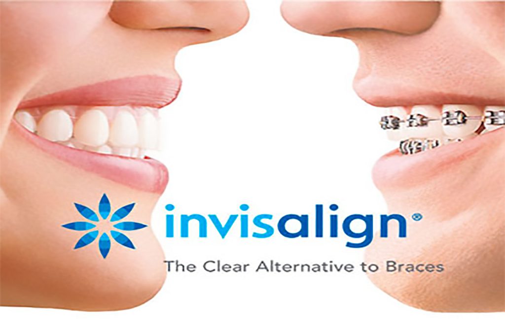 invisalign-clear-alternative